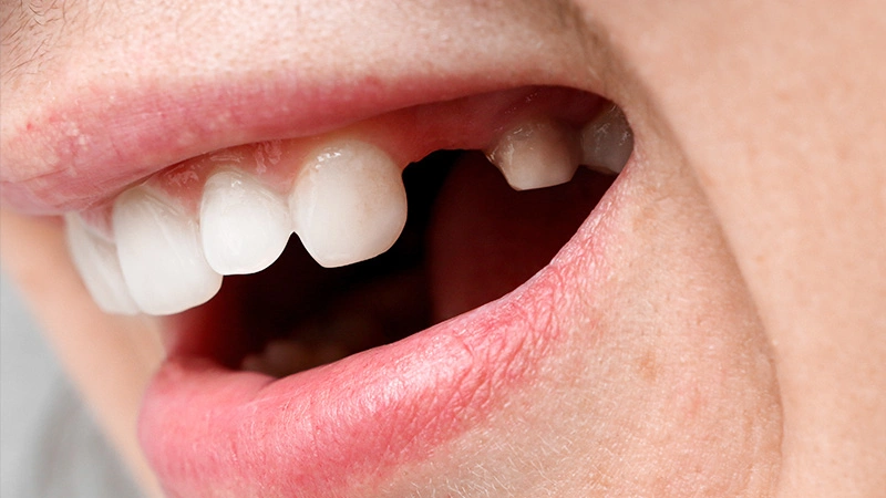 Missing tooth or shifting teeth